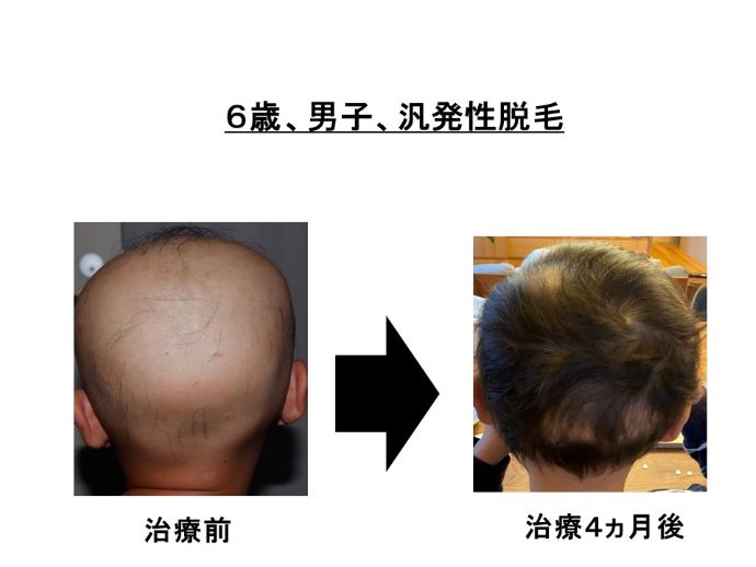 円形脱毛症　病院